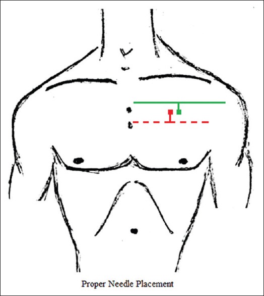 Needle decompression sites