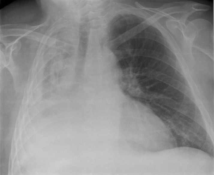 Chest radiograph showing lobar atelectasis with volume loss