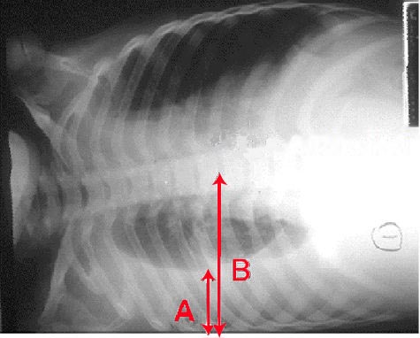 Chest radiograph showing a large pleural effusion with meniscus sign