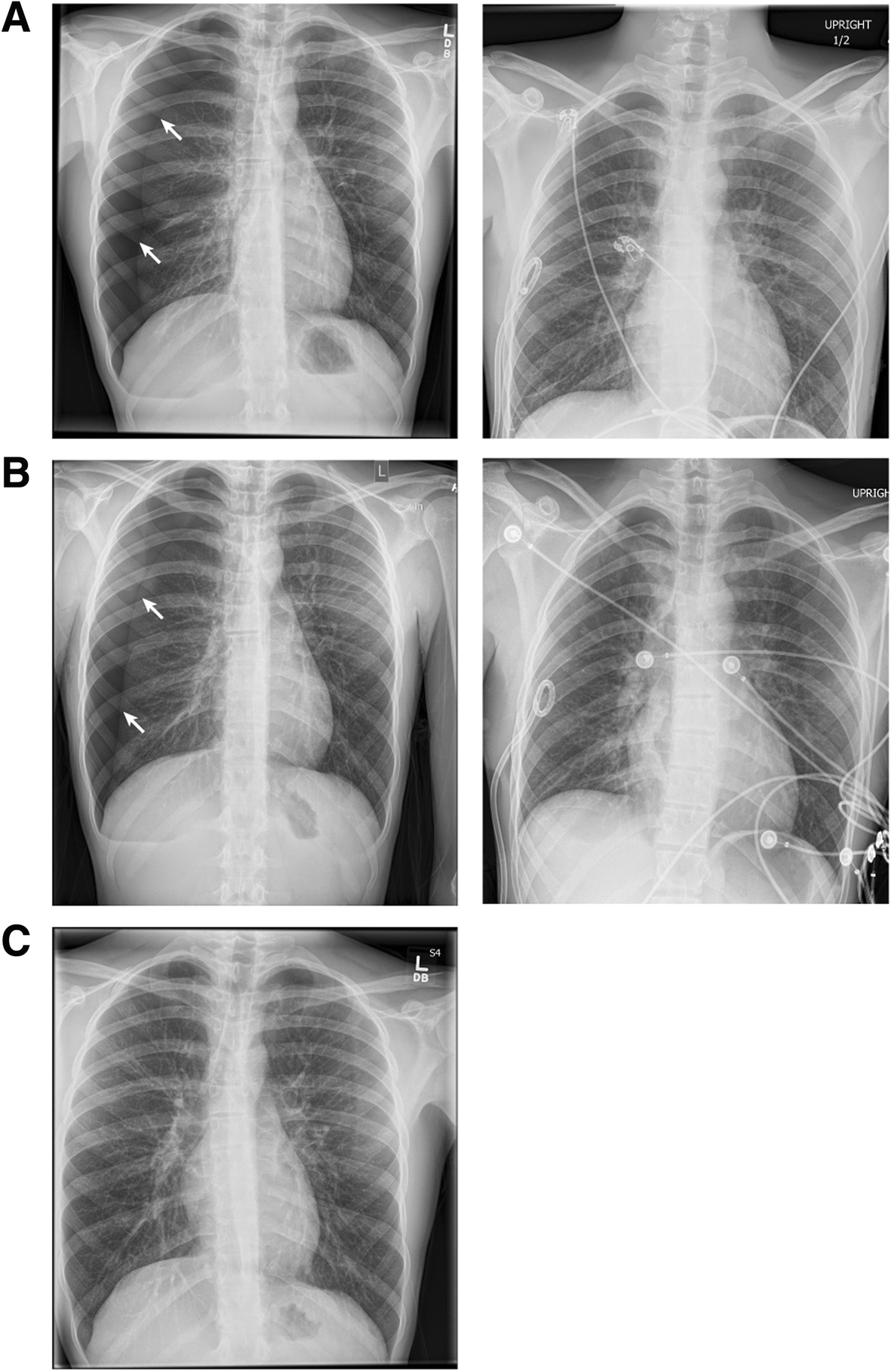 Chest radiograph showing a right-sided pneumothorax with visible pleural line