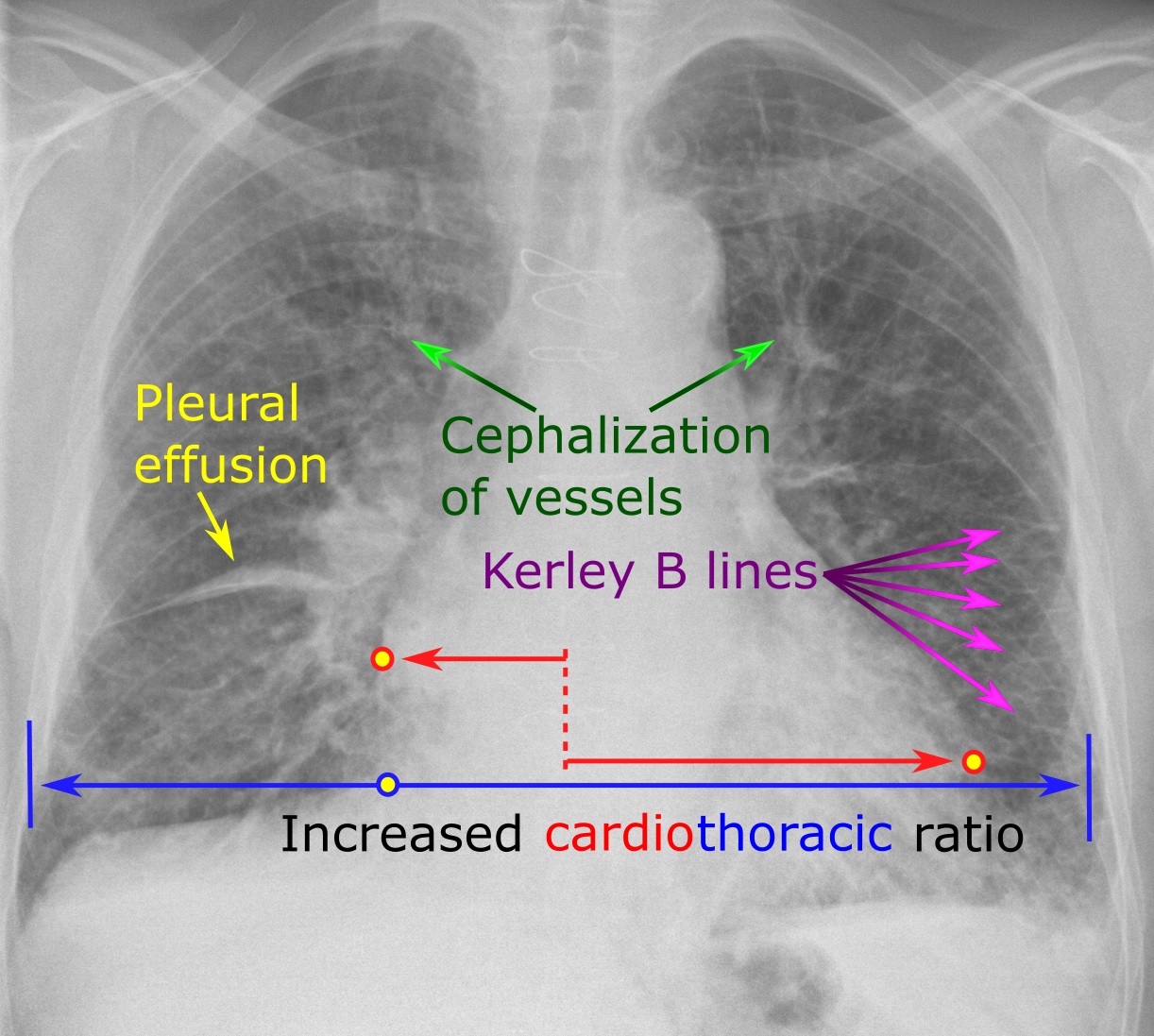 Chest radiograph showing pulmonary oedema with perihilar bat-wing opacities