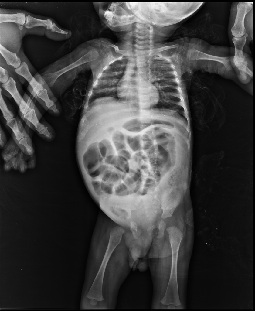 Abdominal radiograph showing colonic dilation consistent with Hirschsprung disease