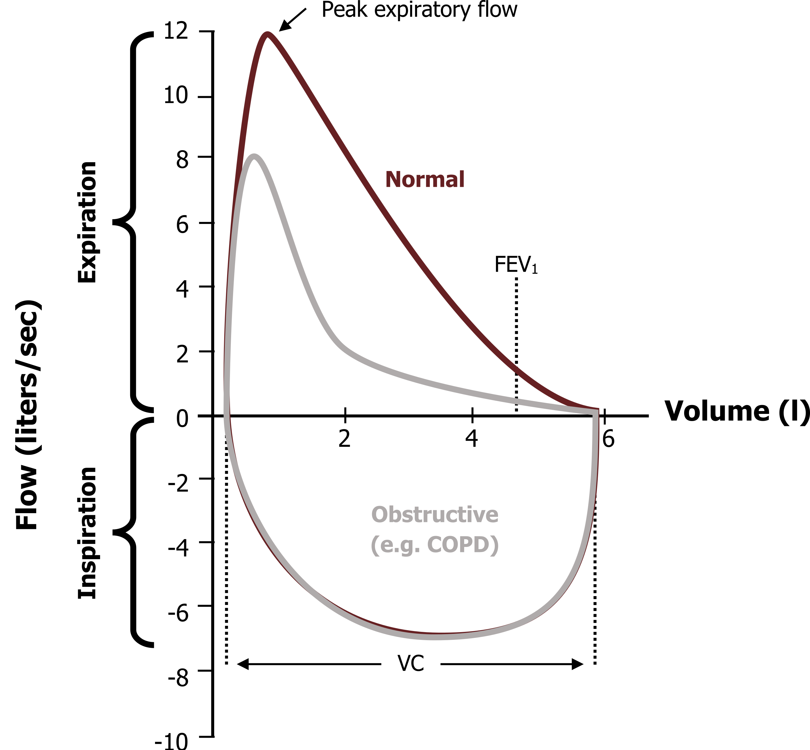 Flow-volume loop showing obstructive pattern with scooped expiratory limb