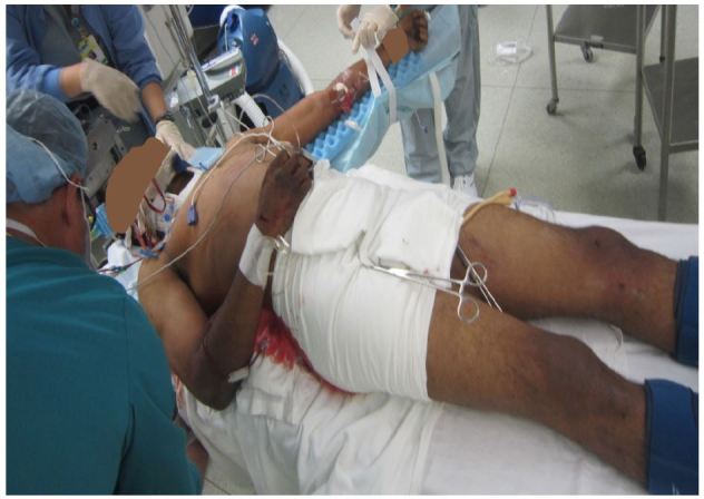 Photo showing correct pelvic binder placement at the level of the greater trochanters