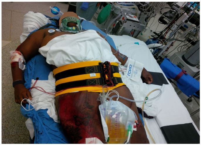 Photo showing incorrect pelvic binder placement too high over abdomen/iliac crests